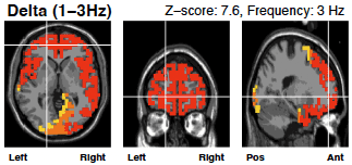 Screenshot 2024-10-28 at 3.02.18 PM Delta wave brain scan before neurofeedback therapy